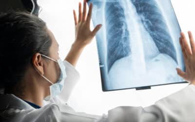 Así es el prometedor tratamiento experimental contra el cáncer de pulmón